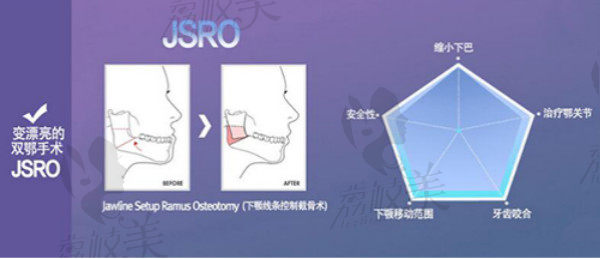 JSRO双鄂整形