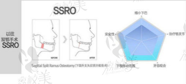 传统双鄂整形SSRO