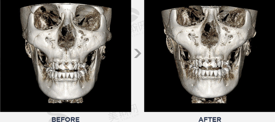 韩国美迪莹整形外科无金属无下垂颧骨缩小术前后对比CT