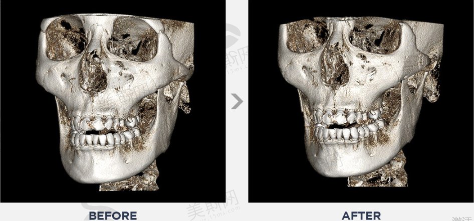 韩国美迪莹整形外科无金属无下垂颧骨缩小术前后对比CT