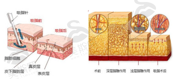 苏州美贝尔SX导航紧肤吸脂术