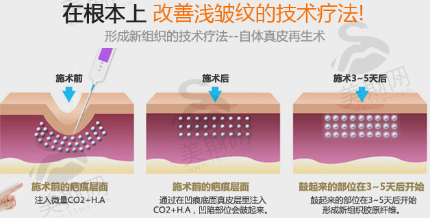 自体真皮再生治疗原理