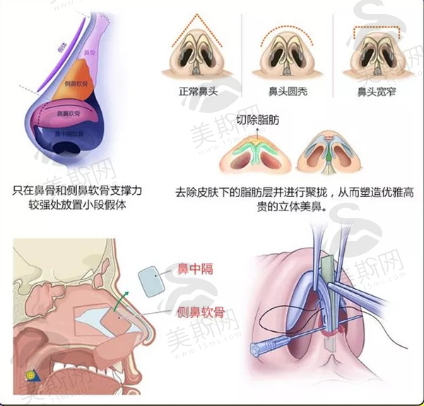 长沙脸博士3V鼻穹隆超精联生植入术