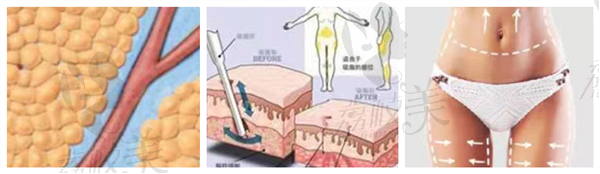 长沙美研高敏院长吸脂优势