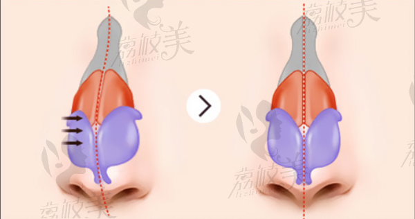 韩国TJ整形张宅镇院长鼻梁弯曲矫正