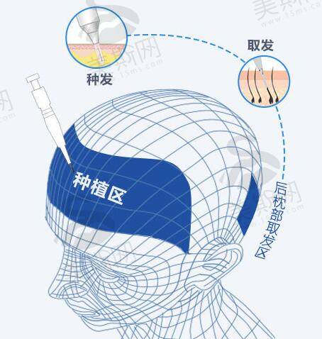 大麦微针植发医院微针植发