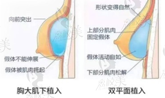 假体植入方式