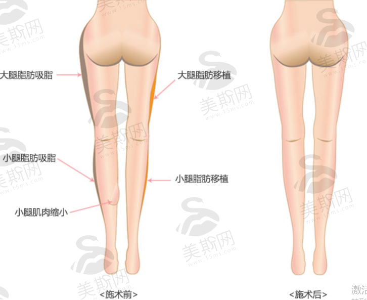 韩国JS美整形外科腿部矫正方案