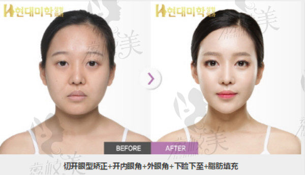 黄虎院长切开眼型矫正+外眼角+下睑下至