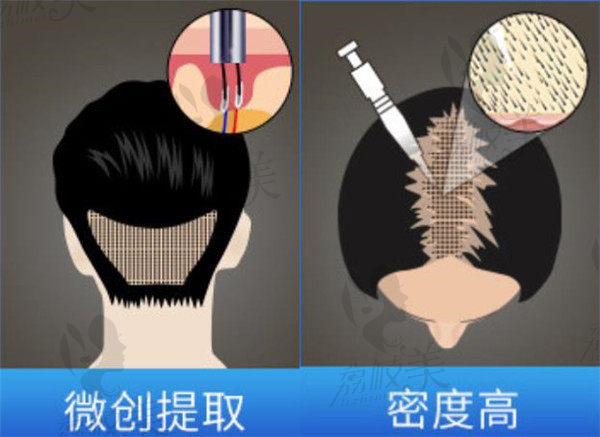 微针加密植发特点