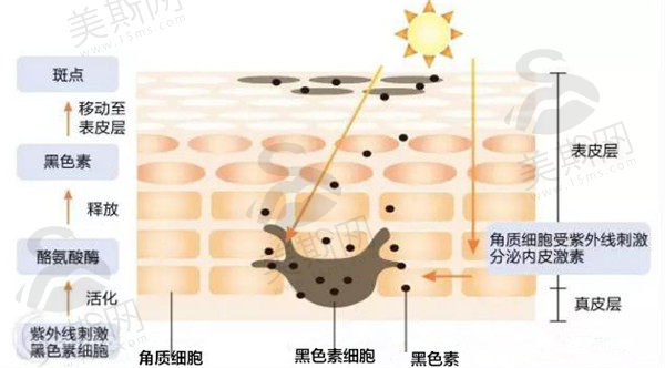 色斑祛除技术 