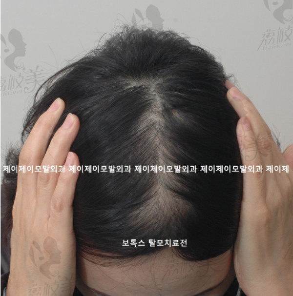朴泰俊院长的发缝加密术前