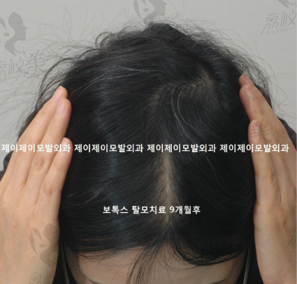 朴泰俊院长的发缝加密术后9个月