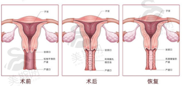 韩国Qline女性医院产道皱成型术