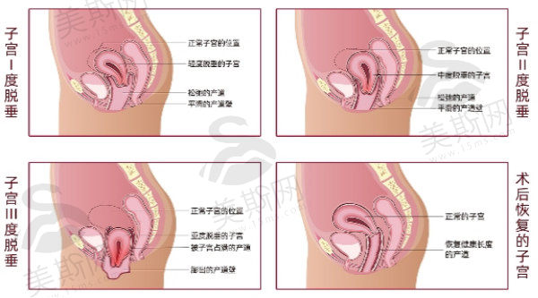 韩国Qline女性医院子宫复位