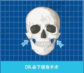 韩国DR.朵下颌角手术