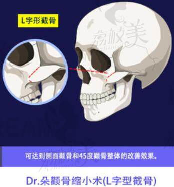韩国DR.朵整形外科颧骨L型截骨