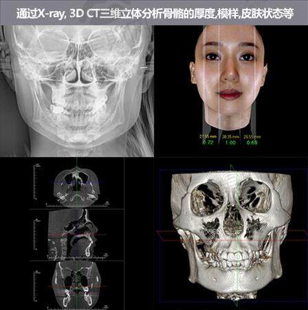 韩国GNG整形轮廓三维立体成像