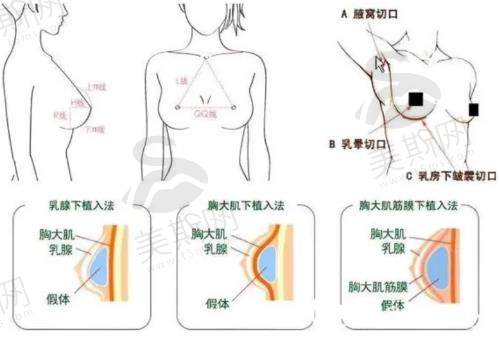 合肥赵辑隆胸