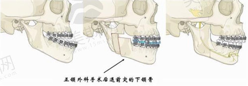 南京友谊整形外科医院有四级手术资质，具备做正颌手术的能力