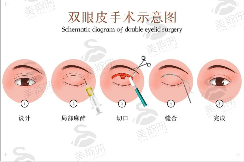 眼皮松弛，该做切眉、提眉、双眼皮还是热玛吉？