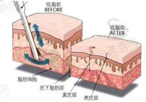 苏州康美吸脂价格