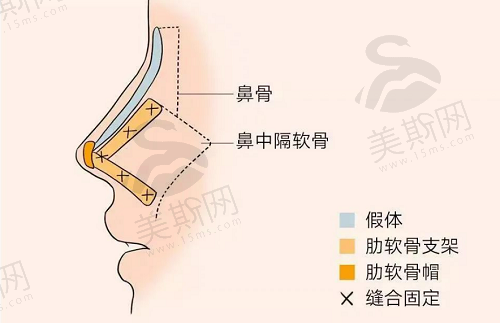 佛山顺德壹加壹肖鹏院长做肋骨鼻综合优势介绍