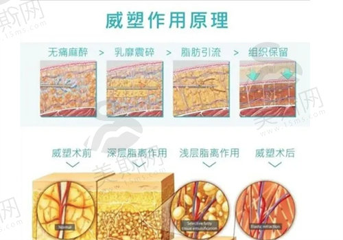 杭州格莱美整形医院超脂塑原理介绍