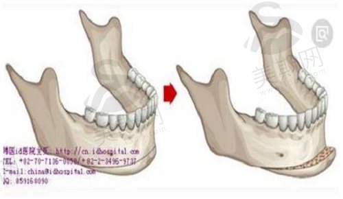 杭州高俊明下颌截骨怎么样