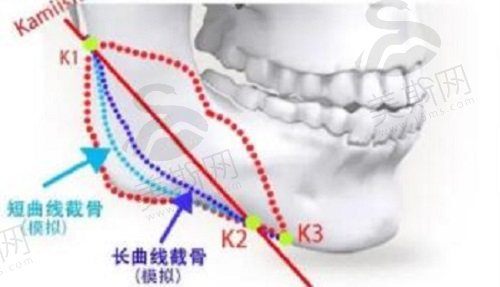 张笑天磨骨技术怎么样？