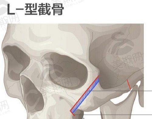 张笑天磨骨技术高，手术基本无误差