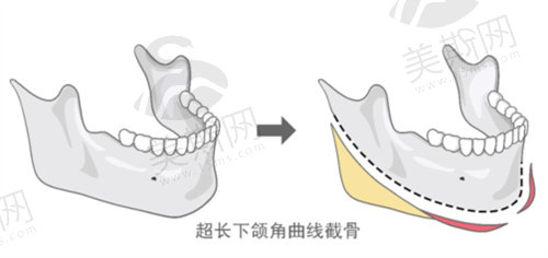 李志海医生超长下颌角曲线截骨手术优势