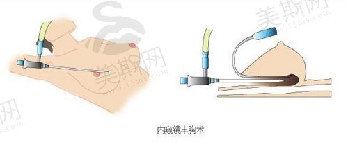 重庆时光整形冯辉利隆胸好的技术特点