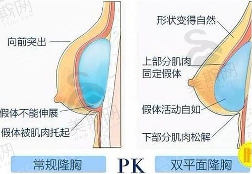 重庆时光整形冯辉利隆胸好的技术特点