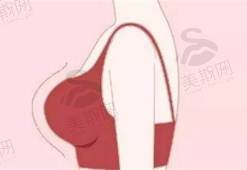 南京艺星整形医院潘峰医生假体丰胸技术娴熟