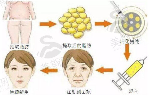 成都八大处唐勇做面部脂肪填充技术先进