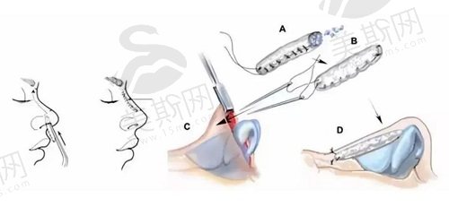 珠海爱思特整形医院鼻部整形新技术