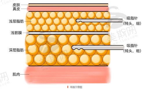 贵阳美贝尔做吸脂手术过程