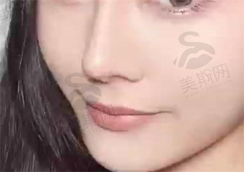 隆鼻22.jpg