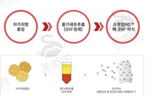 SVF干 细胞阴茎增大增粗手术