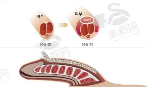韩国世檀塔男科医院做阴茎增大增粗手术价格