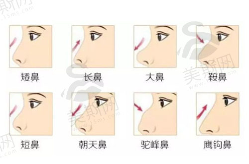 韩国ts整形外科鼻修复挺好的