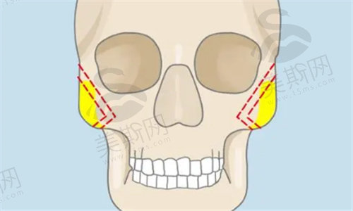 韩国ts整形外科做颧骨缩小手术怎么样
