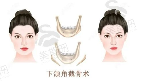 韩国伊美芝金成南院长做下颌角磨骨怎么样