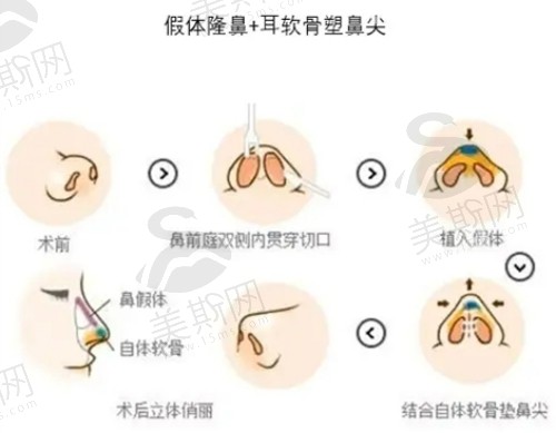 苏州美莱张亮做双侧耳软骨假体隆鼻技术娴熟