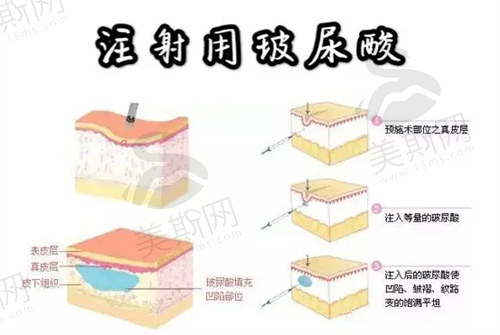 杭州艺星整形的注射玻尿酸口碑不错