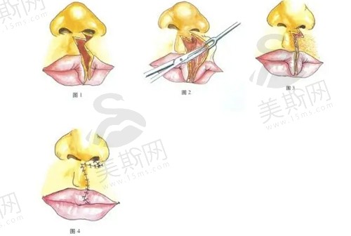 合肥韩美罗定安做唇腭裂手术优势