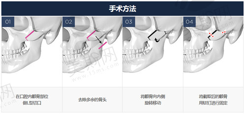 李献和医生做颧骨内推价格实惠