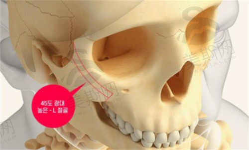 韩国1%整形医院HIGH-3D颧骨缩小手术特色