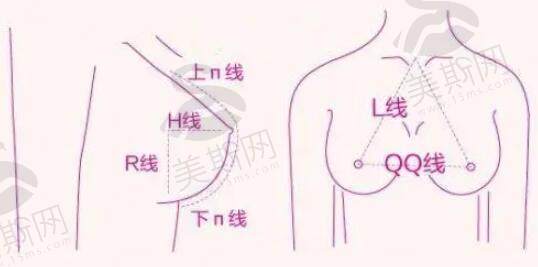 体隆胸手术的切口有几种？